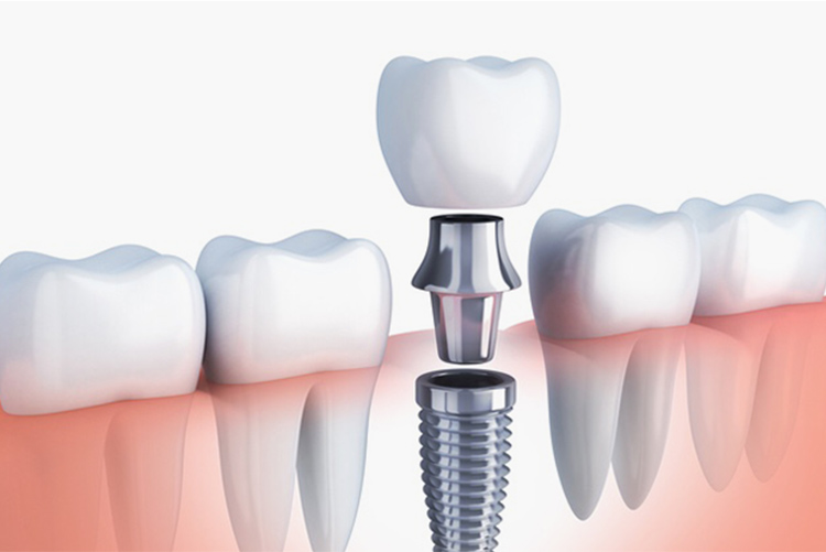 痛みや腫れの少ないインプラント治療 Implants