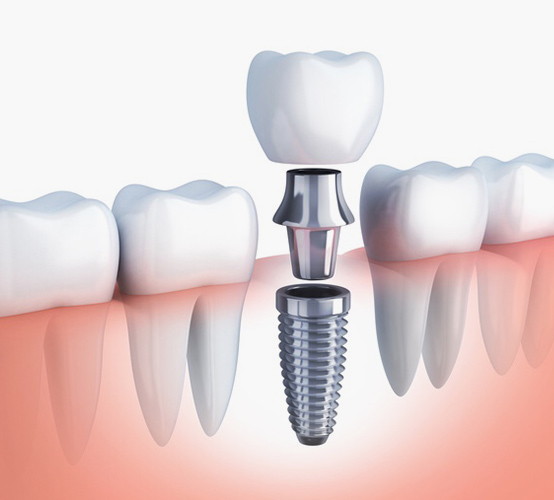 痛みや腫れの少ないインプラント治療 Implants